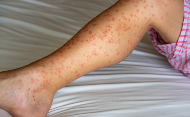 How to Treat Papular Urticaria?