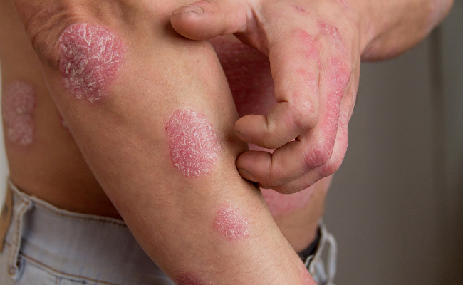 How to Treat Eczema?