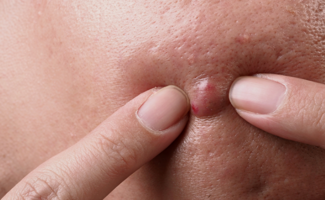 How to Treat Furuncles And Skin Abscesses?