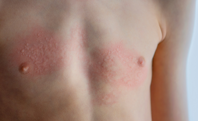How to Treat Erythema Multiforme?