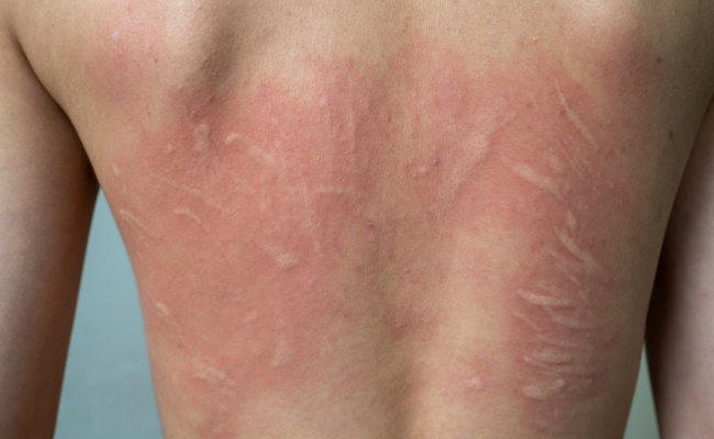 How to Treat Urticaria General?