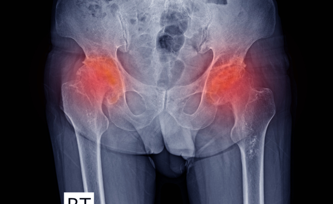 How to Treat Avascular Necrosis?