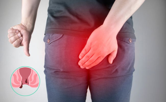 How to Treat Perianal Abscess?