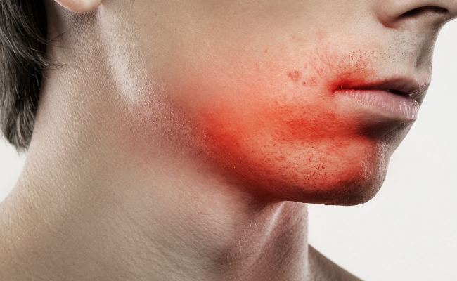 How to Treat Razor Bumps?