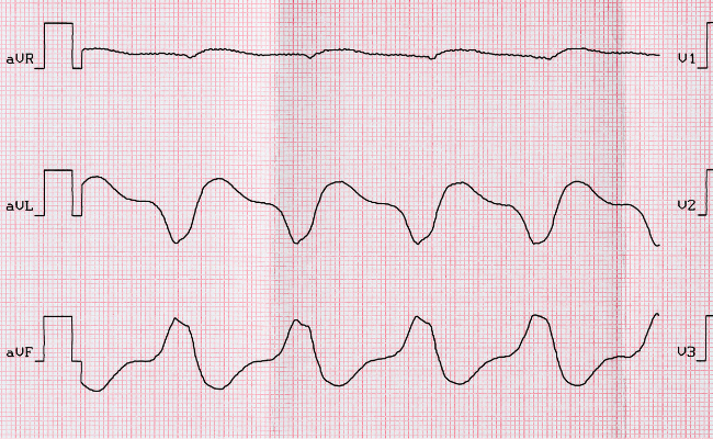How to Treat Nonsustained Irregular Wide Qrs Tachycardias?