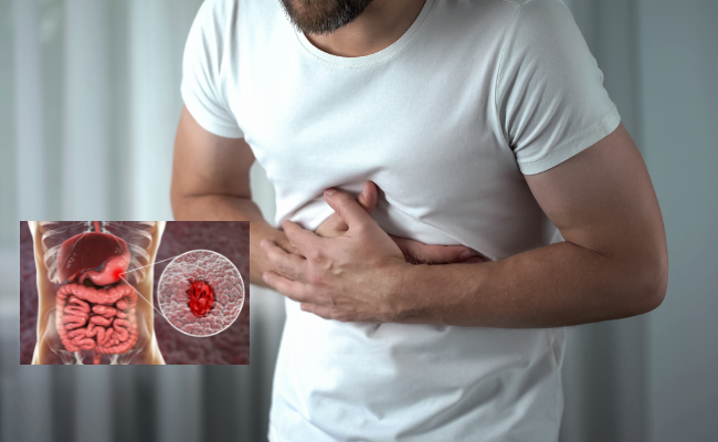How to Treat Peptic Ulcer?