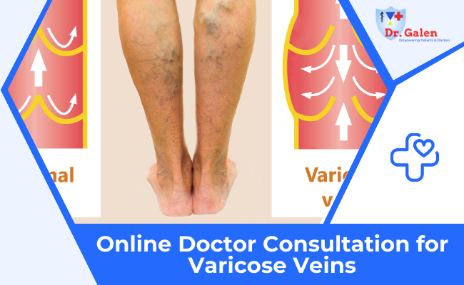 Online Doctor Consultation for Varicose Veins