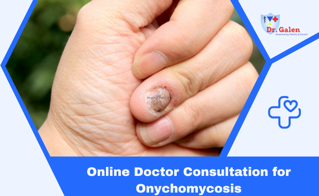 Online Doctor Consultation for Onychomycosis